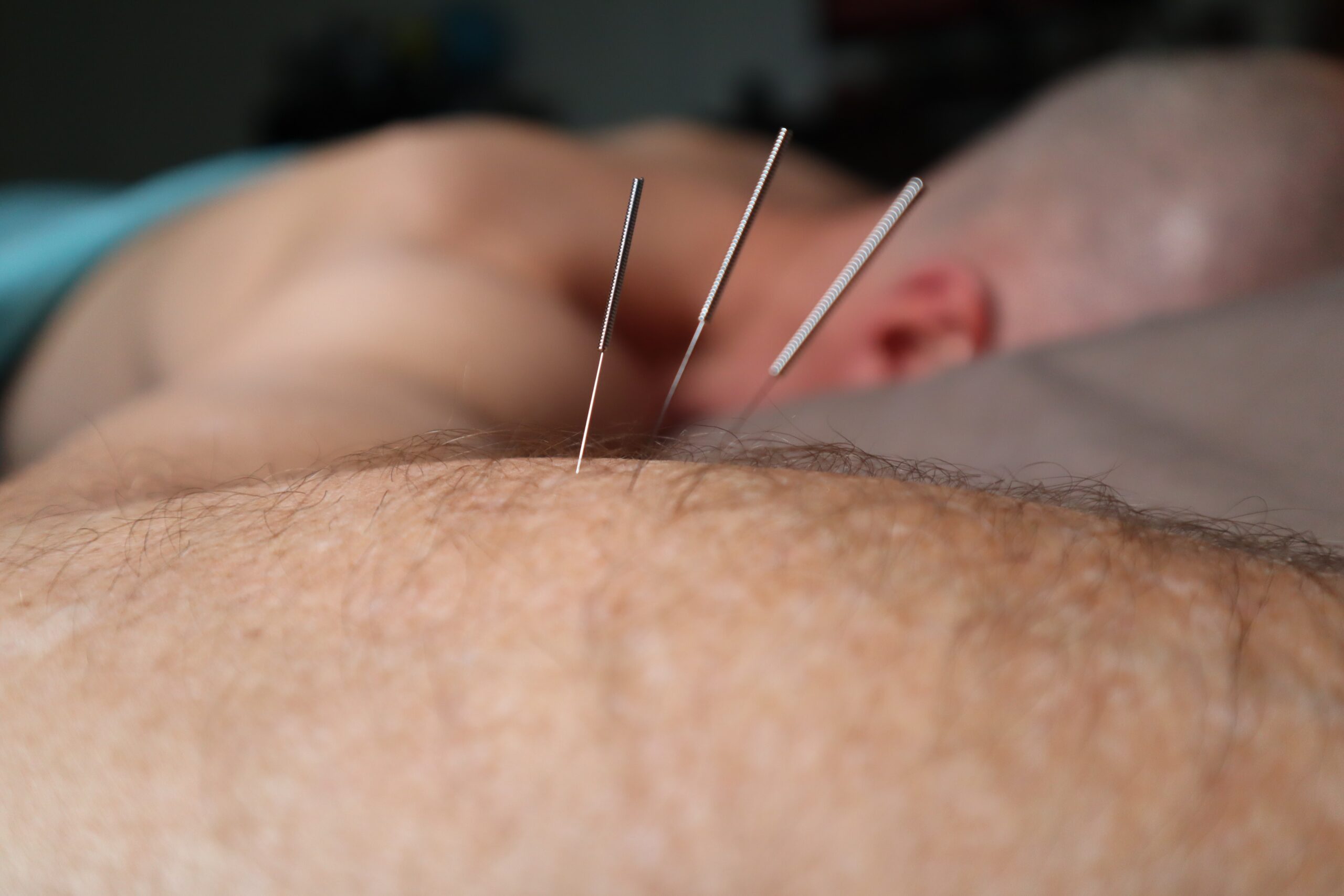 Er zijn vaak nog vragen over de effecten van acupunctuur. In deze blog worden de vragen beantwoord.